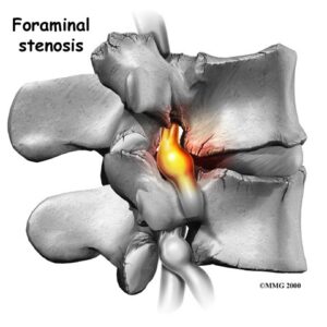 estenosis foraminal columna lumbar nervio ciático Santiago
