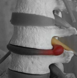 hernia discal lumbar compresión nervio ciático tratamiento quiropráctico